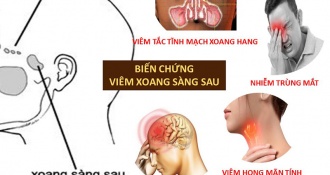 Viêm xoang sàng: Triệu chứng và cách điều trị được chuyên gia khuyên dùng